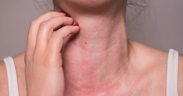 skin rash from food allergy